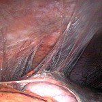 Abbildung: Foto einer Adhäsion im Bauchraum, eine Verwachsung zwischen einem Organ und dem Bauchfell