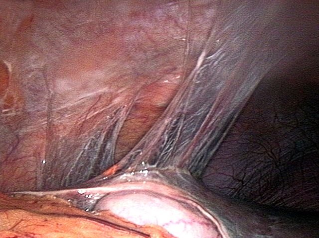 Abbildung: Foto einer Adhäsion im Bauchraum, eine Verwachsung zwischen einem Organ und dem Bauchfell
